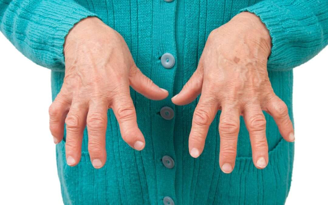 CBD for Arthritis