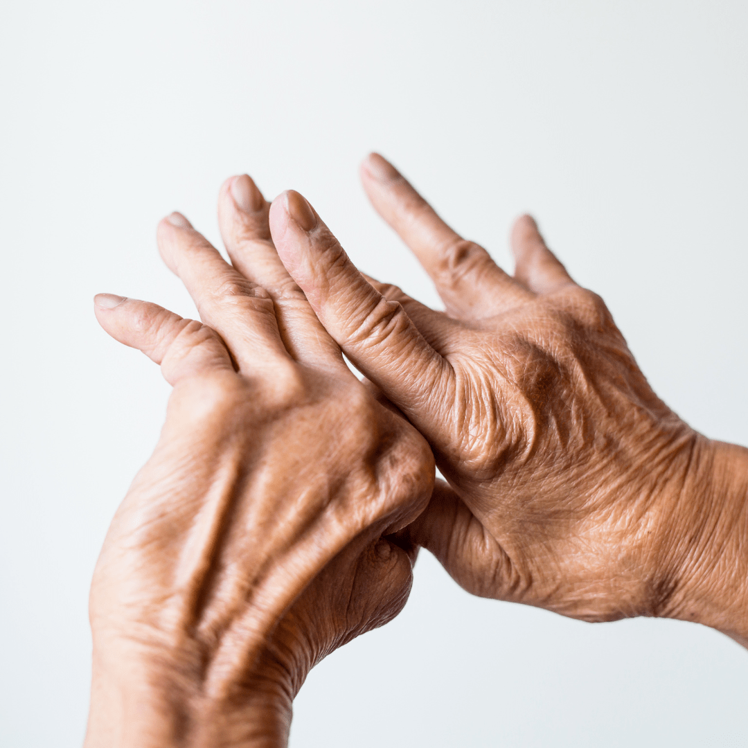 Close-up of a woman's hands displaying severe arthritis symptoms, with visible swelling and joint deformity.