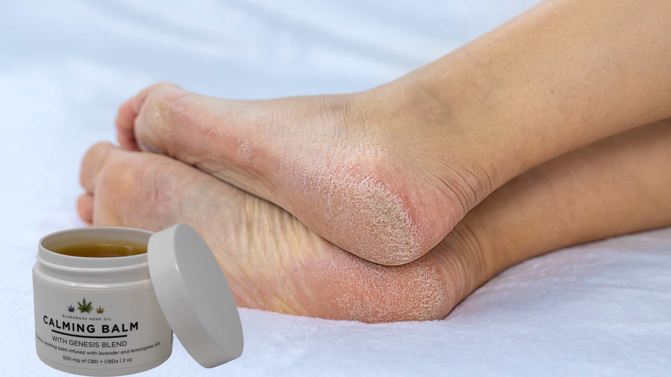 Close-up of dry, cracked feet with a jar of Genesis Blend CBD Calming Balm from Bluegrass Hemp Oil, made by Kentucky Cannabis Company, ideal for soothing and moisturizing dry skin.